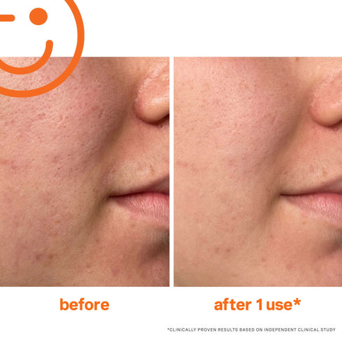 ExfoliKate Intensive Exfoliating Treatment - GLAM MODA