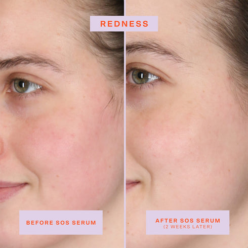 SOS Intensive Redness Relief Serum with Hypochlorous Acid - GLAM MODA