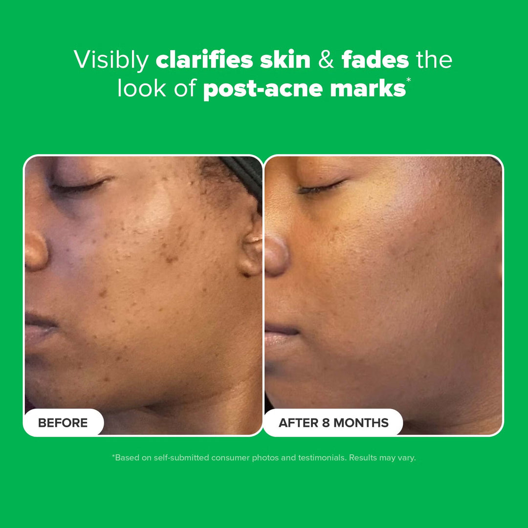 10% Azelaic Acid Booster 30ml - GLAM MODA