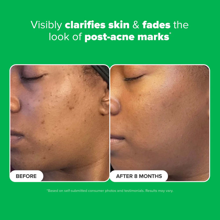 10% Azelaic Acid Booster 30ml - GLAM MODA