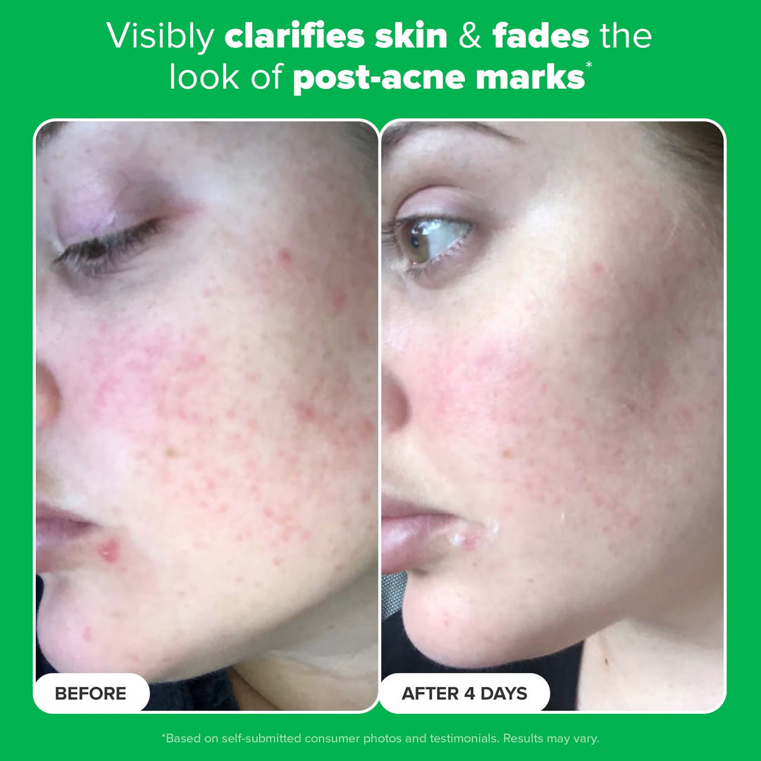 10% Azelaic Acid Booster 30ml - GLAM MODA