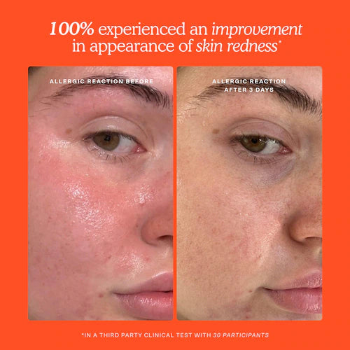 SOS Daily Hypochlorous Acid Spray for Breakouts & Redness