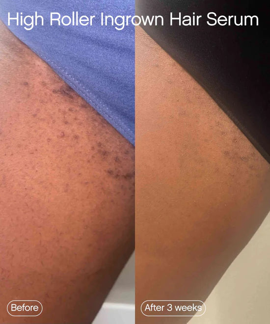 "High Roller Ingrown Tonic - GLAM MODA"