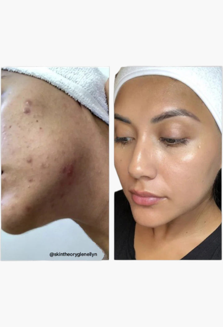 8% Mandelic Acid Serum - GLAM MODA