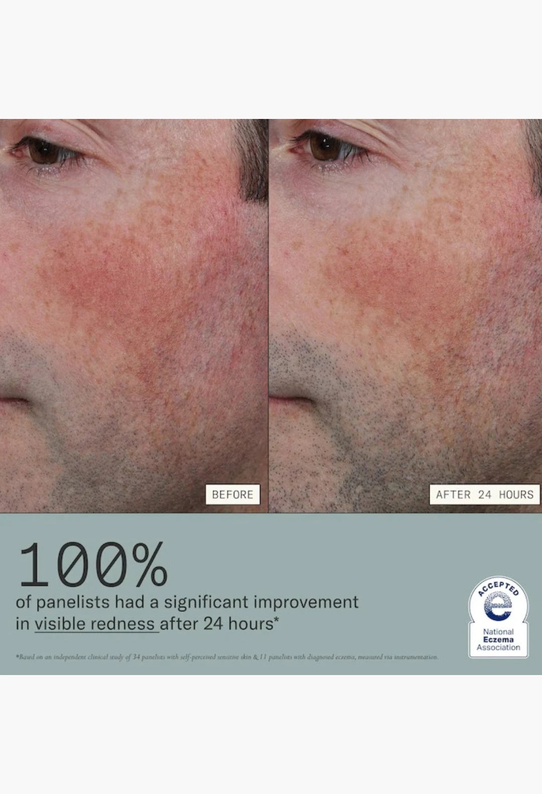 Skin Mercy Intense Recovery Cream for Sensitive & Eczema-Prone Skin