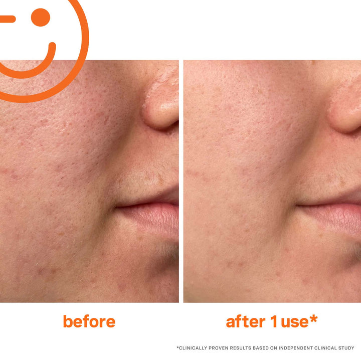 ExfoliKate Intensive Exfoliating Treatment - GLAM MODA