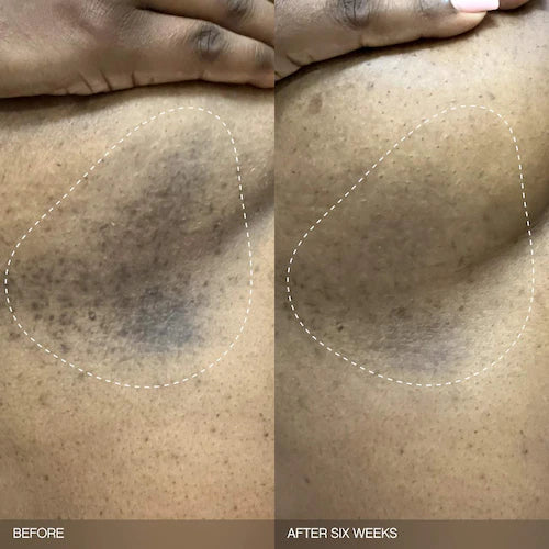 Faded Brightening Bundle for Discoloration on Face & Body (UNSCENTED) - GLAM MODA