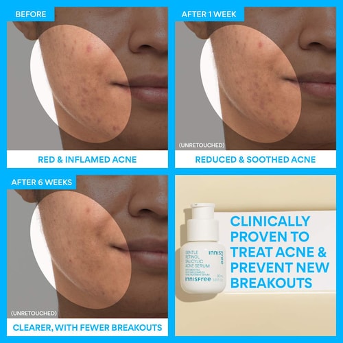 Gentle Retinol Salicylic Acne Serum - GLAM MODA