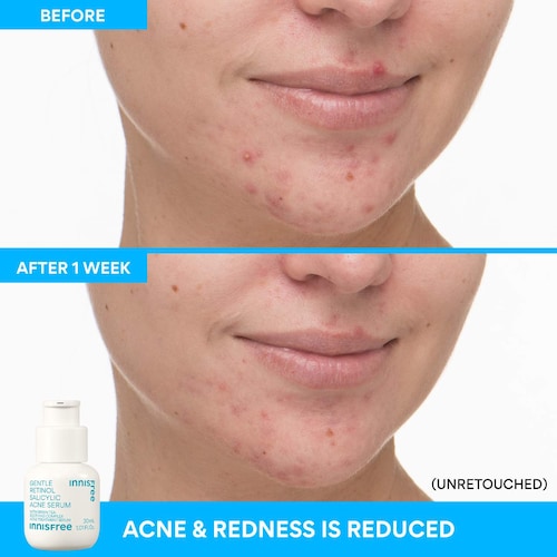 Gentle Retinol Salicylic Acne Serum - GLAM MODA