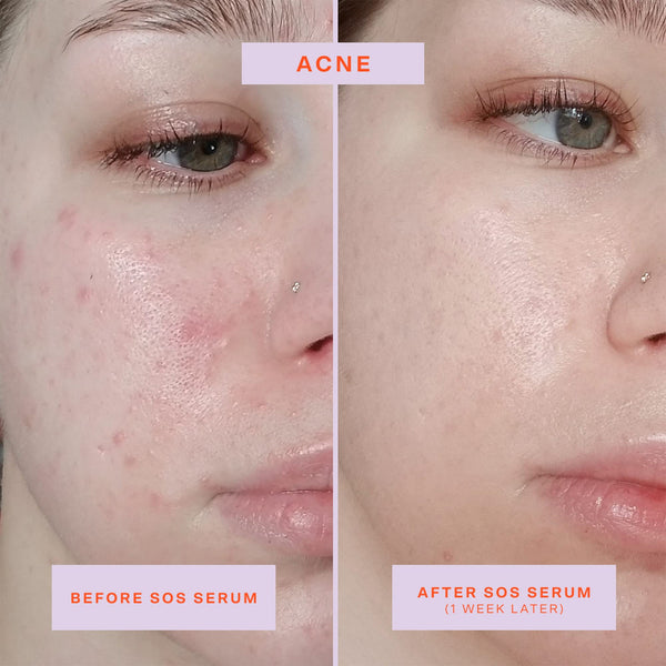SOS Intensive Redness Relief Serum with Hypochlorous Acid