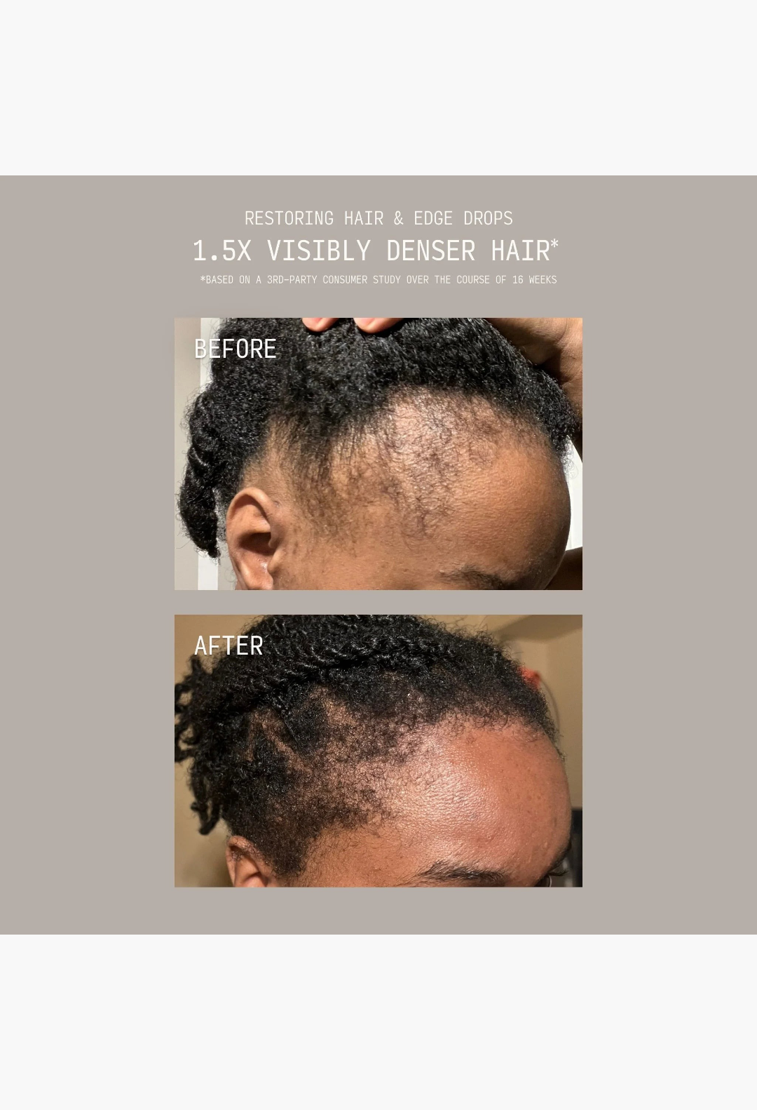 GLAM MODA before and after results showing hair density improvement on the scalp and edges after using hair drops.