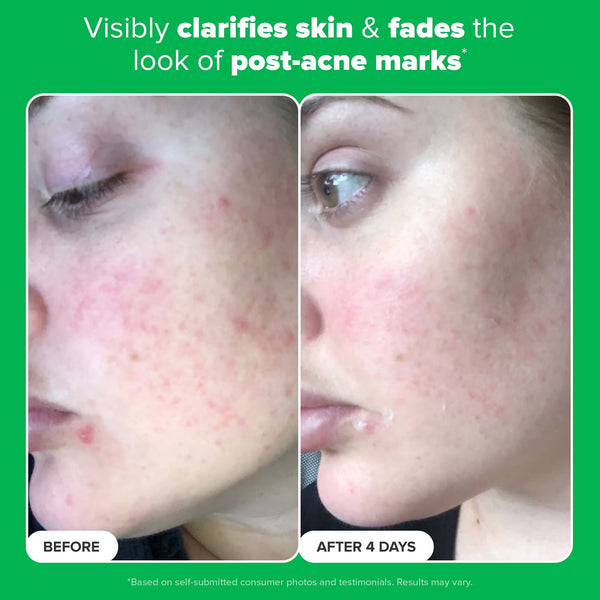10% Azelaic Acid Booster 30ml