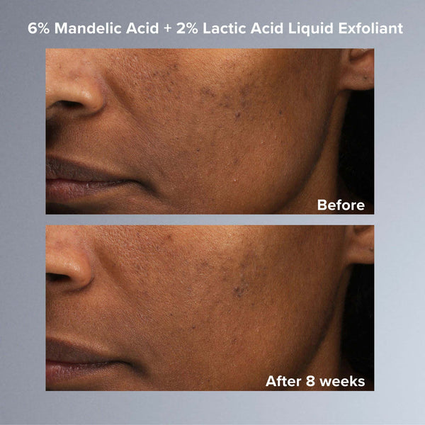 Multi-Level Exfoliation Set