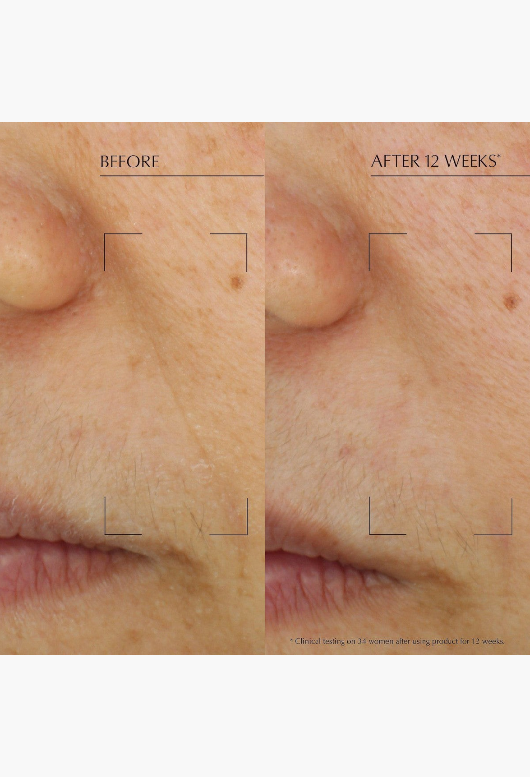 GLAM MODA before and after skin comparison showing improved firmness and reduced lines after 12 weeks of treatment.