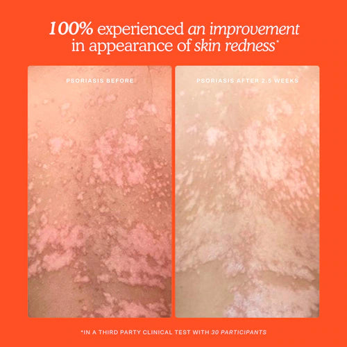 SOS Daily Hypochlorous Acid Spray for Breakouts & Redness - GLAM MODA