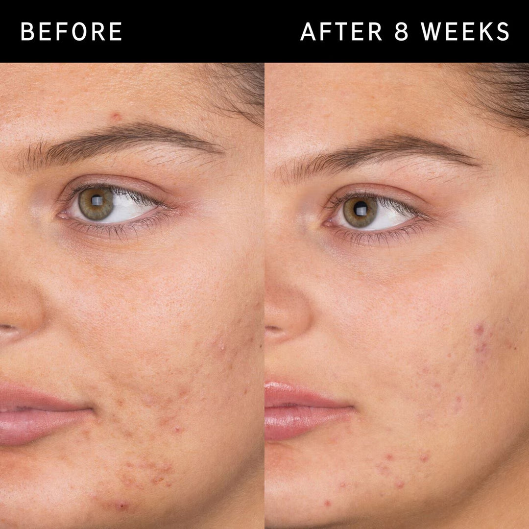 Salicylic Acid Cleanser - GLAM MODA