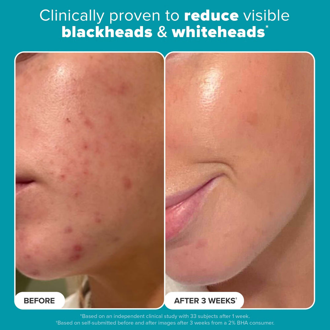 Skin Perfecting 2% BHA Liquid Exfoliant - GLAM MODA