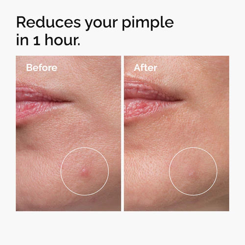 Sulfur 10% Powder-to-Cream Concentrate Acne Spot Treatment - GLAM MODA