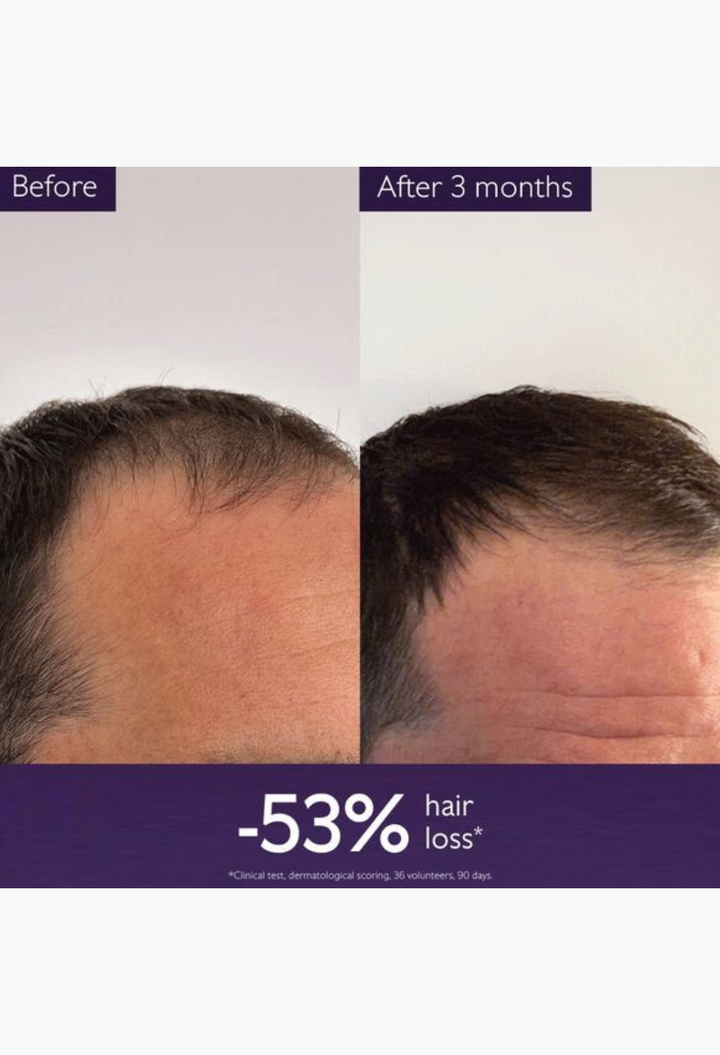 GLAM MODA before and after results of hair thickening serum showing reduced hair loss and increased density