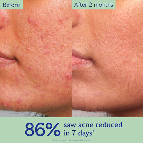 Vinopure Acne Serum to Treat and Prevent Blemishes - GLAM MODA