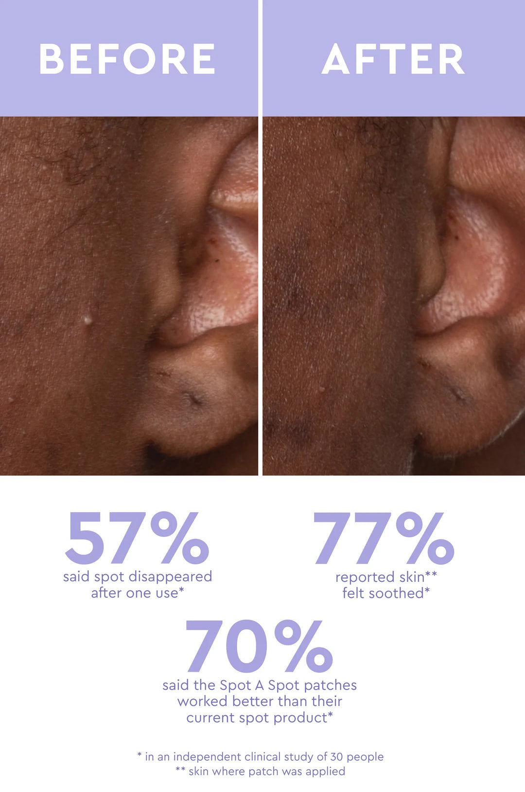 Spot A Spot Acne Patches - GLAM MODA