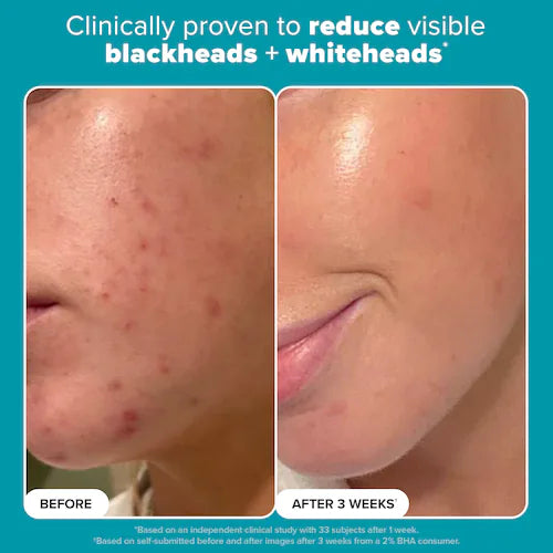 Skin Perfecting 2% BHA Exfoliating Toner For Clear Skin