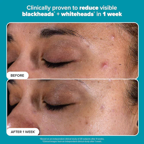 Skin Perfecting 2% BHA Exfoliating Toner For Clear Skin