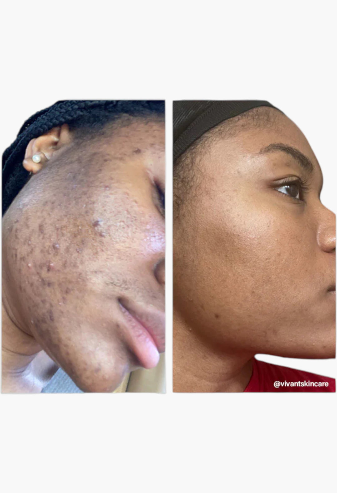 8% Mandelic Acid Serum - GLAM MODA