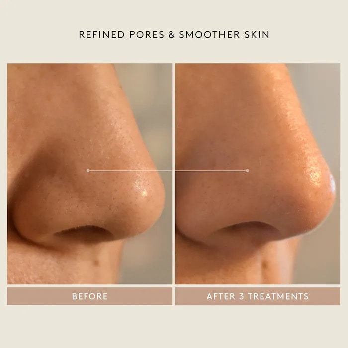 Triple Acid Signature Peel - GLAM MODA