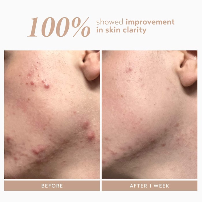 Rescue Serum With 10% Azelaic Complex for Dark Spots - GLAM MODA