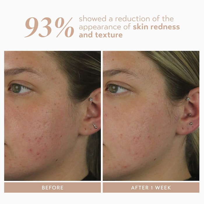 Rescue Serum With 10% Azelaic Complex for Dark Spots - GLAM MODA