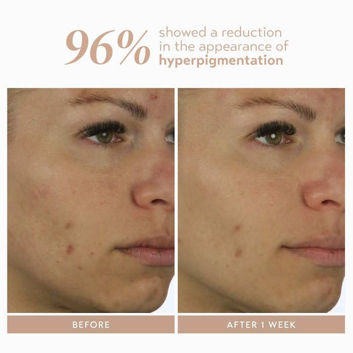 Rescue Serum With 10% Azelaic Complex for Dark Spots - GLAM MODA