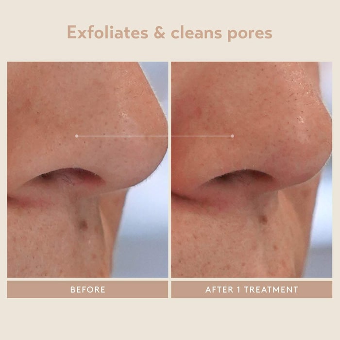 Triple Acid Signature Peel - GLAM MODA