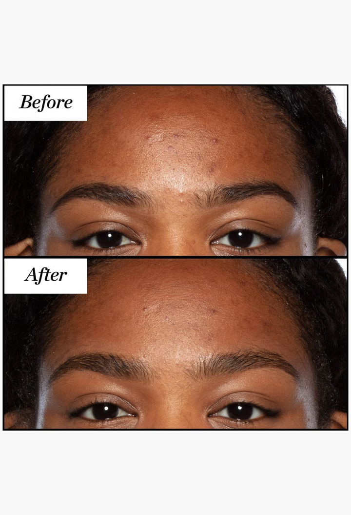 GLAM MODA before and after comparison of skin texture and clarity after using Sunday Riley Good Genes treatment