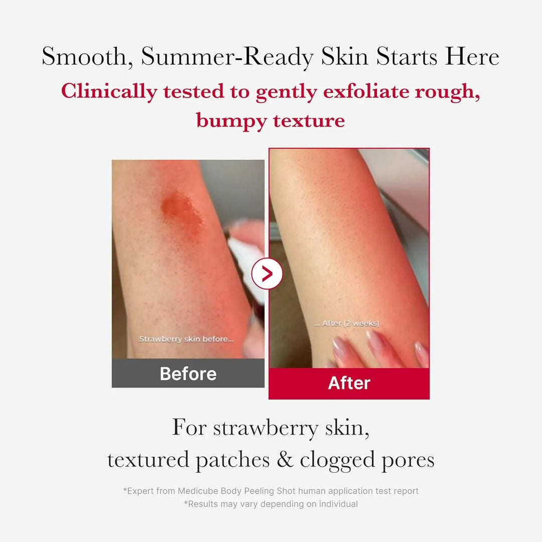 Red Acne Body Peeling Shot ( Not For Face ) - GLAM MODA
