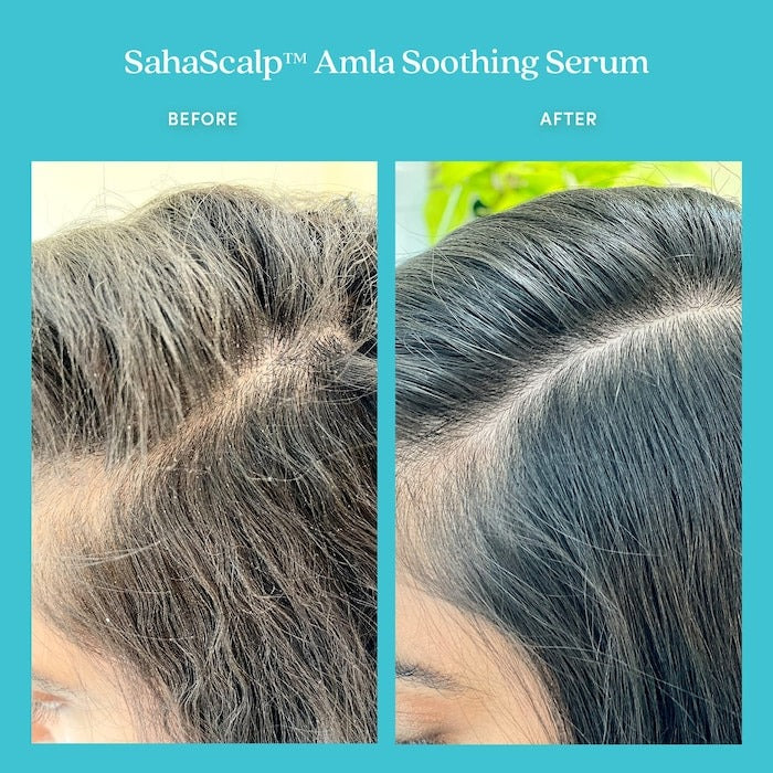 SahaScalp™ Amla Soothing Serum - GLAM MODA