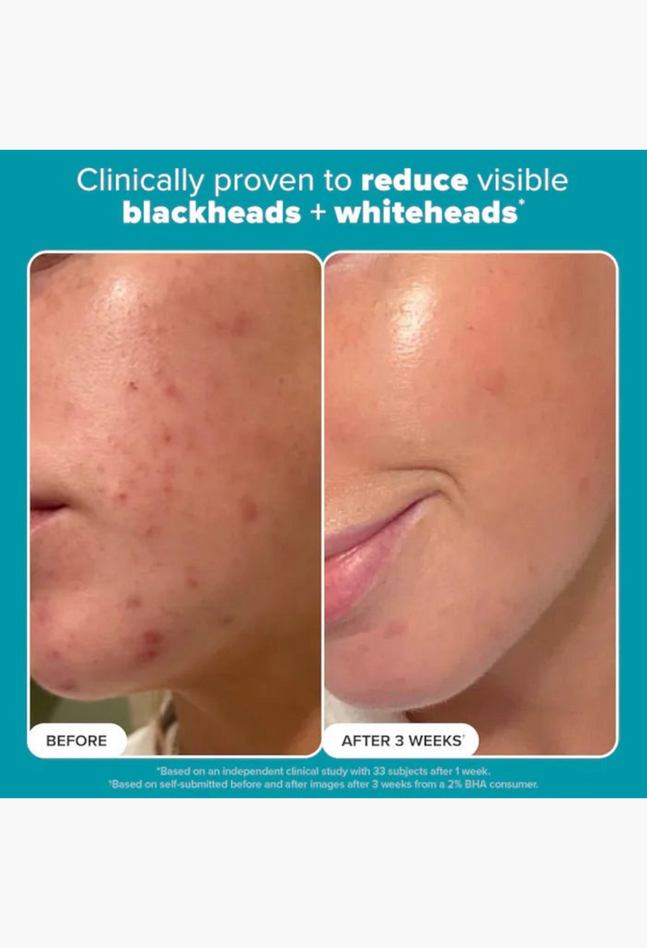 GLAM MODA before and after results showing clearer skin texture and reduced blemishes after using 2% BHA toner.