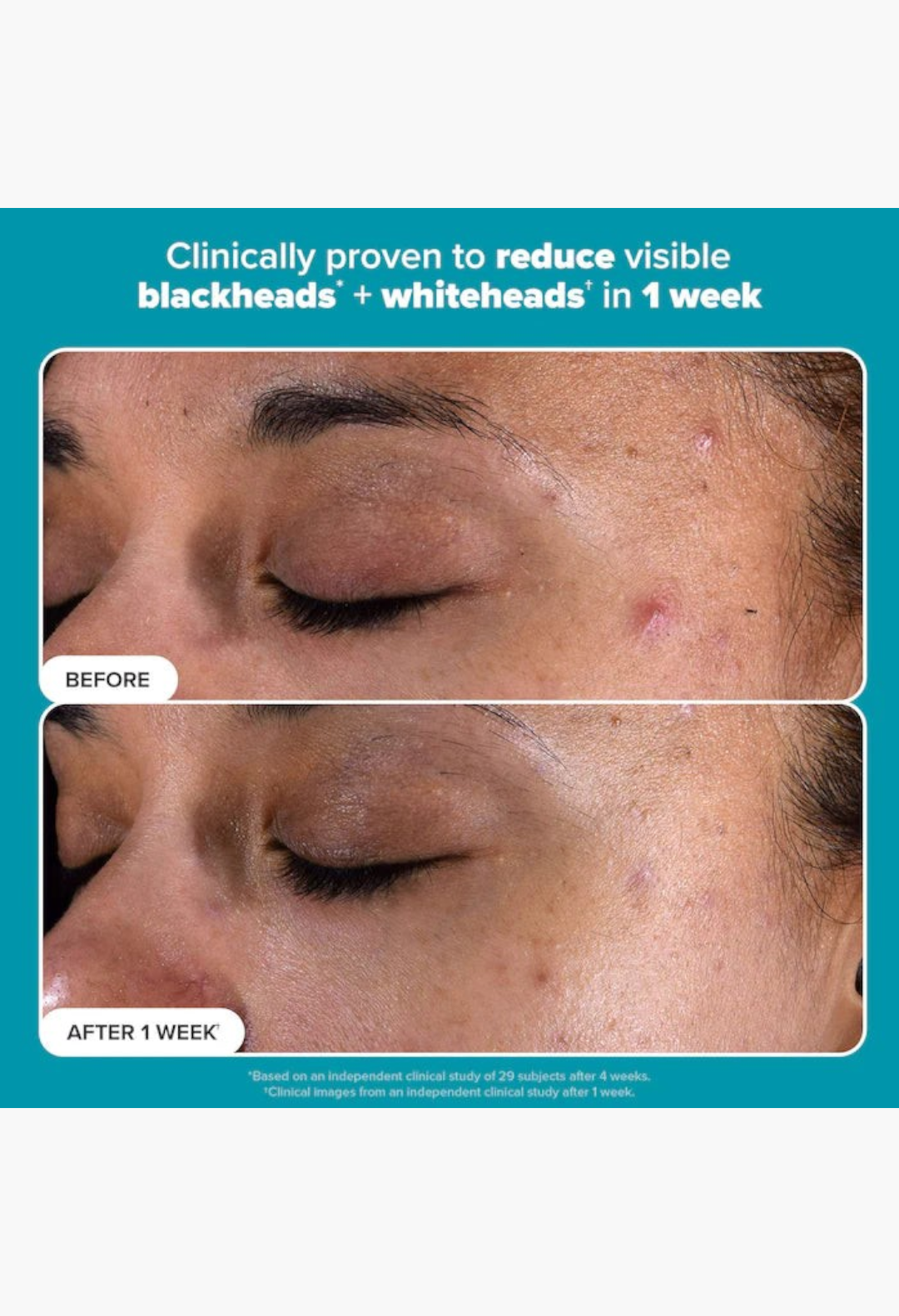 GLAM MODA before and after results showing reduced blemishes and clearer skin after one week of using BHA toner.
