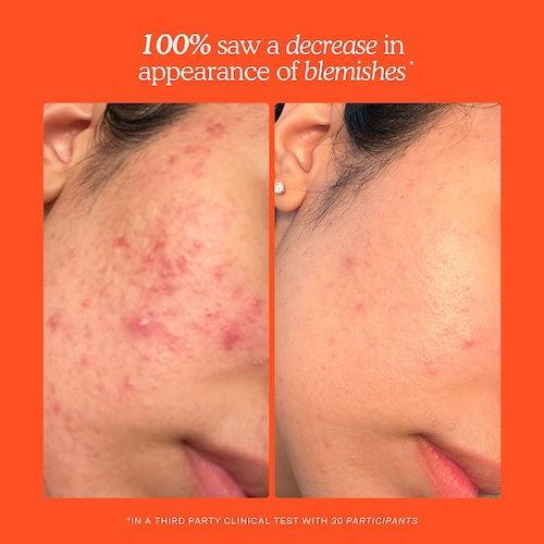 SOS Daily Hypochlorous Acid Spray for Breakouts & Redness