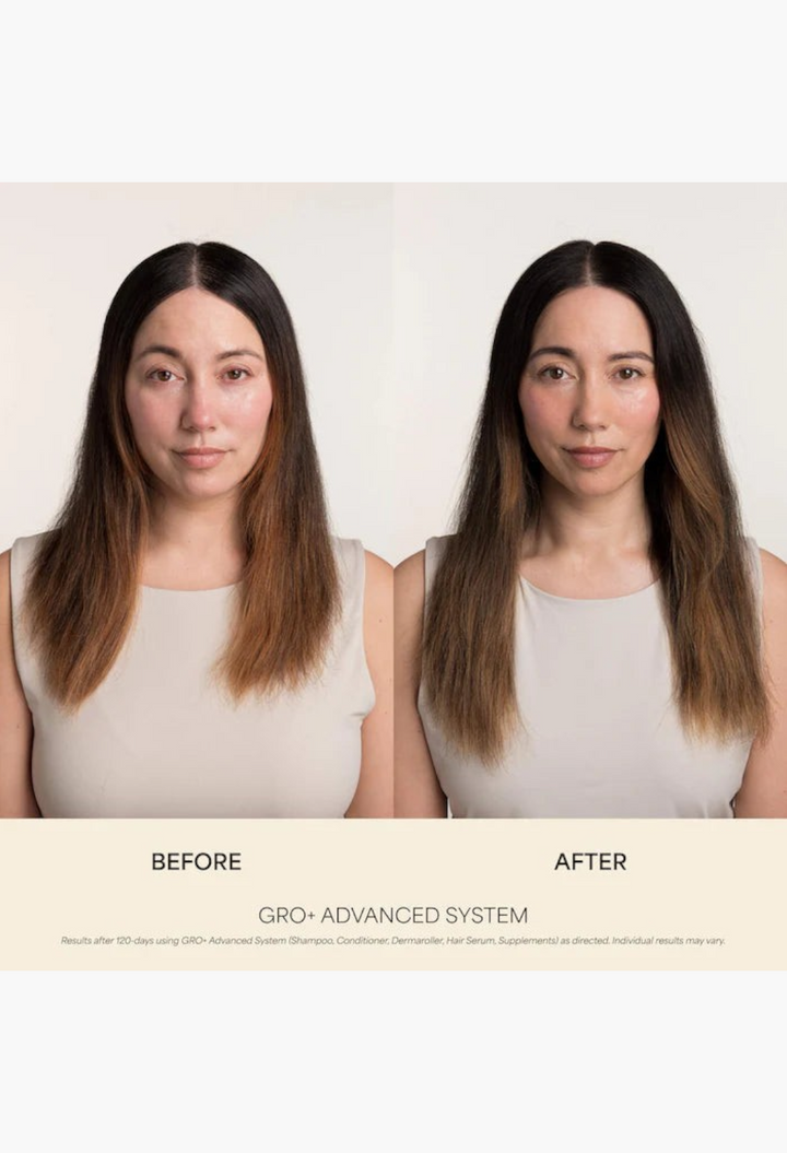 GLAM MODA before and after comparison of a woman showing hair density improvement using the GRO+ Advanced System.