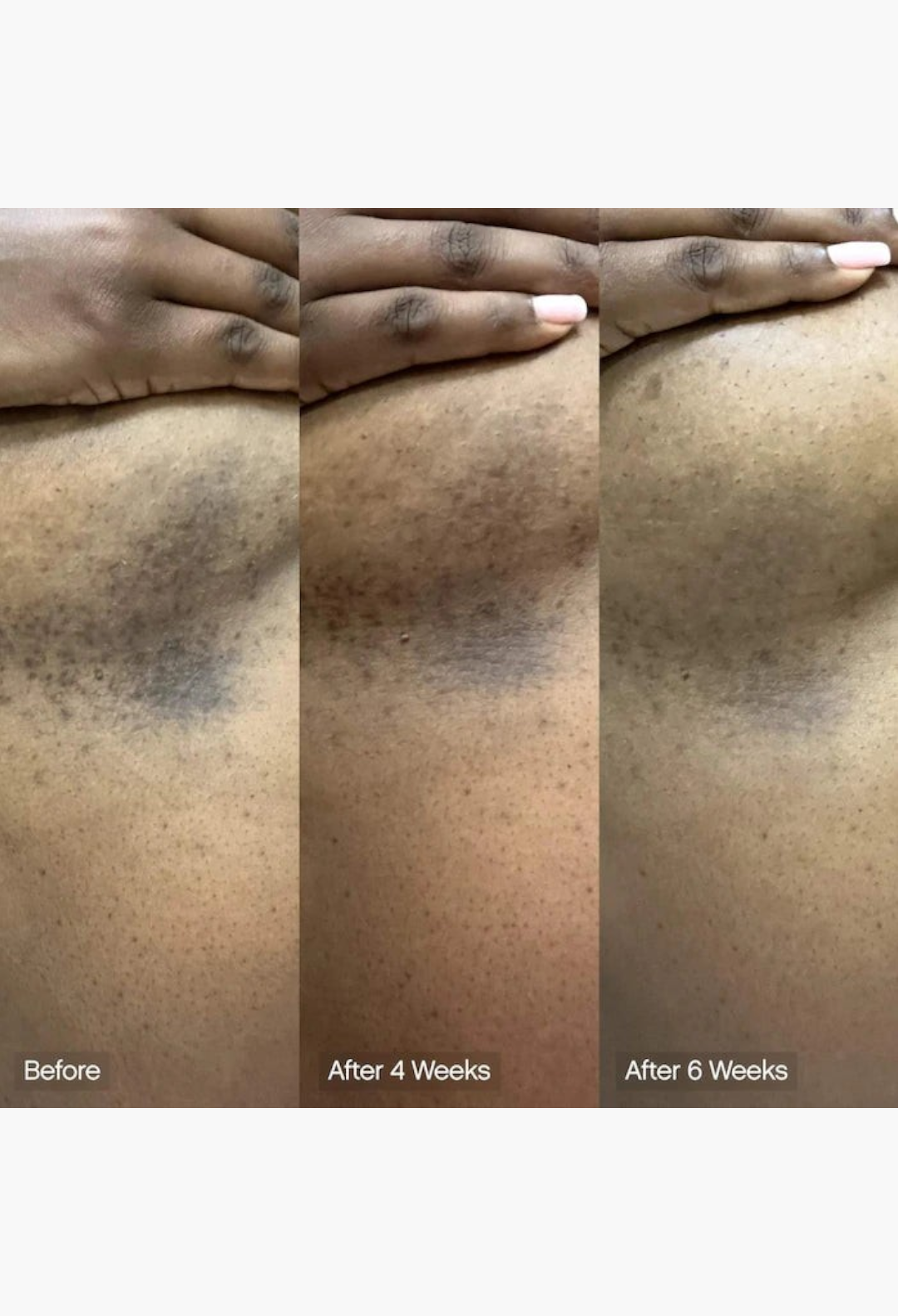 GLAM MODA before and after results of brightening body bar showing reduced dark spots on skin over six weeks