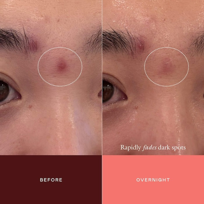 The Mark Advanced Targeted Dark Spot Concentrate with 5% Tranexamic Acid, 1% Alpha Arbutin & 1% Kojic Acid for Hyperpigmentation, Acne Marks & Age Spots - GLAM MODA