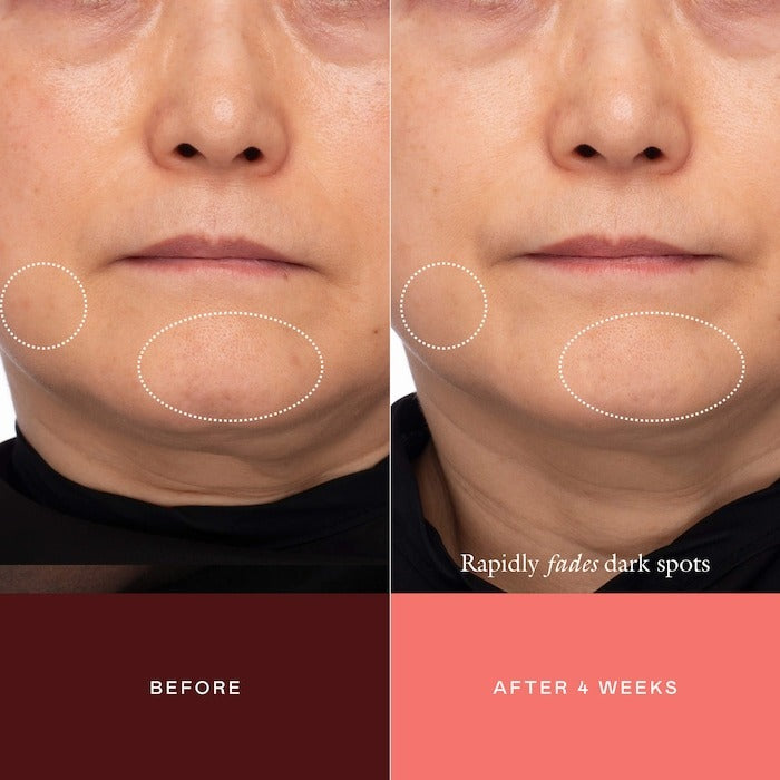 The Mark Advanced Targeted Dark Spot Concentrate with 5% Tranexamic Acid, 1% Alpha Arbutin & 1% Kojic Acid for Hyperpigmentation, Acne Marks & Age Spots - GLAM MODA