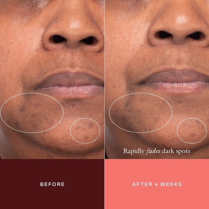 The Mark Advanced Targeted Dark Spot Concentrate with 5% Tranexamic Acid, 1% Alpha Arbutin & 1% Kojic Acid for Hyperpigmentation, Acne Marks & Age Spots - GLAM MODA