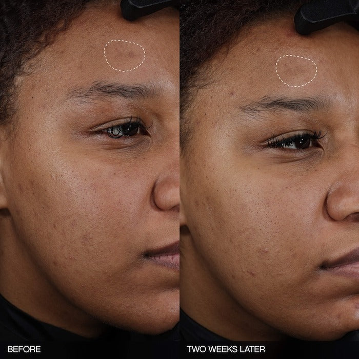 Faded Tranexamic Acid Dark Spot Patches for Hyperpigmentation - GLAM MODA