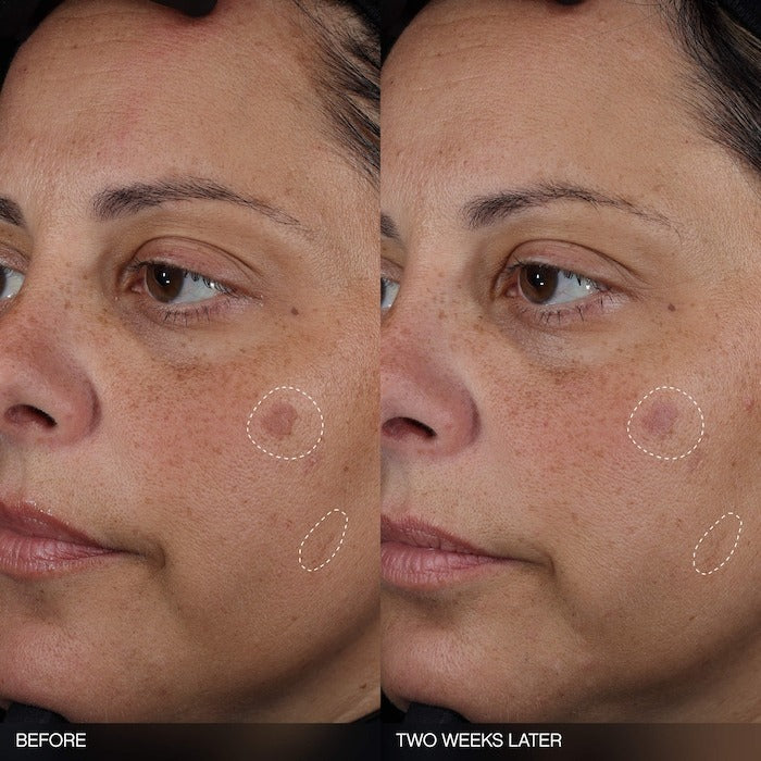 Faded Tranexamic Acid Dark Spot Patches for Hyperpigmentation - GLAM MODA